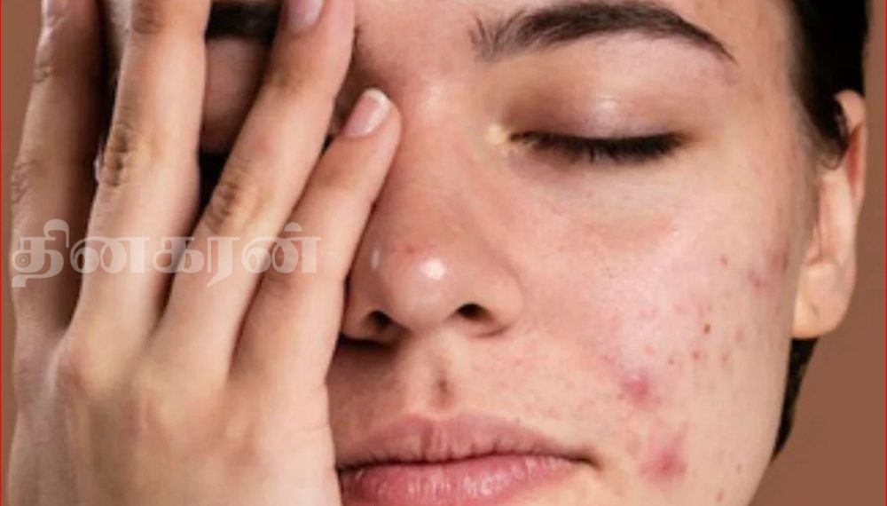 முகப்பரு வராமல் இருக்க தவிர்க்க வேண்டிய உணவுகள்!
