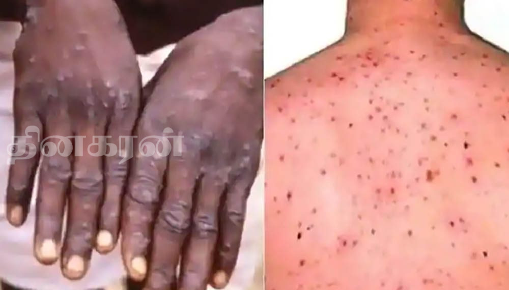 தென்னாபிரிக்காவில் மூவருக்கு குரங்கம்மை பாதிப்பு!